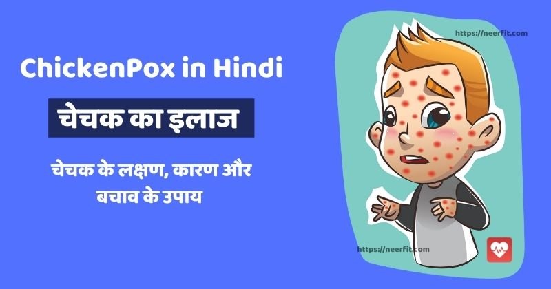 Chicken pox in hindi