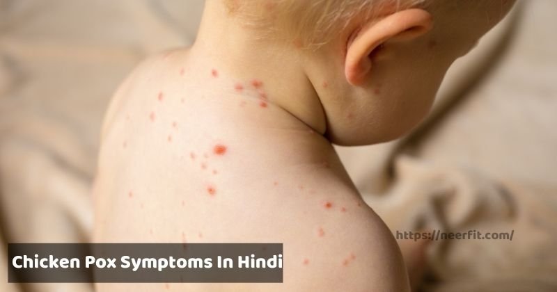 chicken pox symptoms in hindi