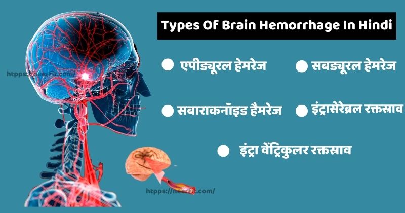 Types of Brain Hemorrhage in Hindi
